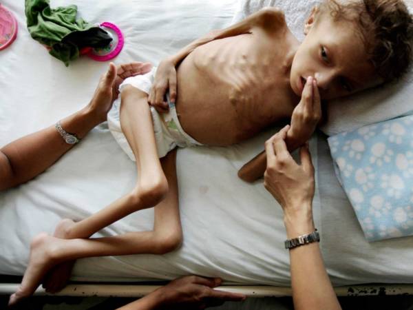 Голодные дети в Йемене